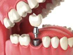 dental implants manhasset ny