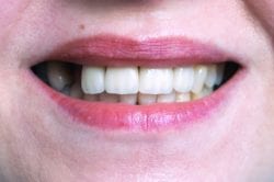 dental implants in roslyn heights, new york
