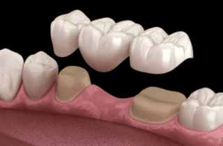 3D render of a dental bridge hovering over a gap in teeth dental bridges restorative dentistry dentist in Roslyn Heights New York
