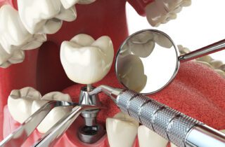 DENTAL IMPLANTS in Roslyn Heights, NY can help maintain your bite's strength
