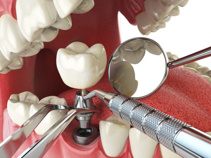 DENTAL IMPLANTS in Roslyn Heights, NY can help maintain your bite's strength