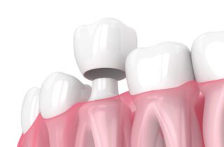 DENTAL CROWNS in ROSLYN HEIGHTS NY need proper protection and care