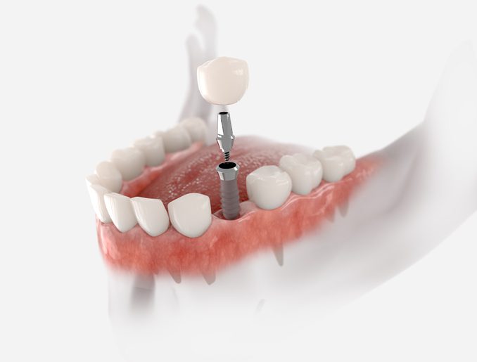 learn more about dental implants in Roslyn Heights, NY