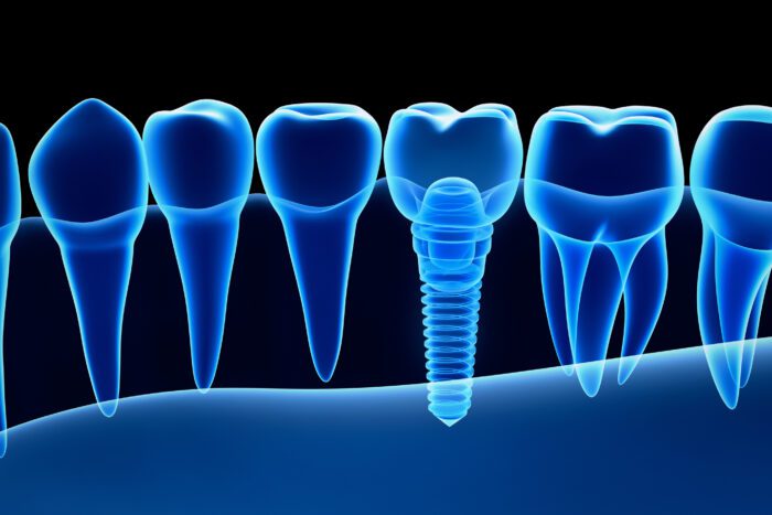 dental implant process in Roslyn Heights, NY