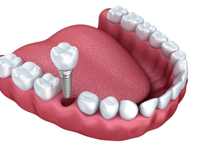 single dental implant in Roslyn Heights, NY