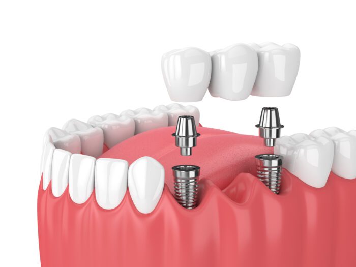 multiple dental implants in Roslyn Heights, NY