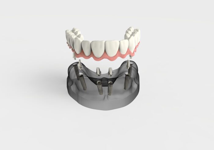 implant dentures in Roslyn Heights, NY
