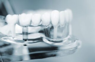 DENTAL IMPLANTS in ROSLYN HEIGHTS NY could help restore your bite and smile