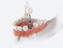 The Truth About Dental Implants in Roslyn Heights